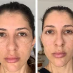 melasma 1