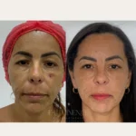 melasma 4