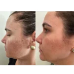 melasma 5