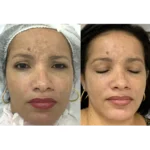 melasma 7